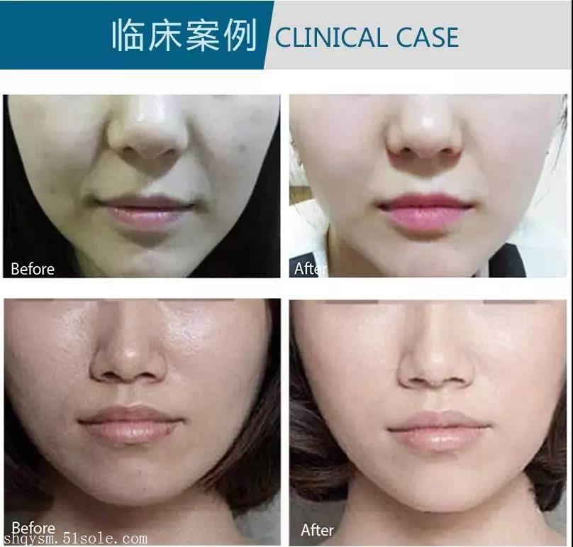 德玛莎二代水光仪仪器